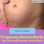 10 Tips To Prevent Pregnancy Stretch Marks - Medixgo