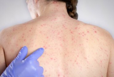 Measles outbreak raises concerns in Central Florida | Credits: Adobestock