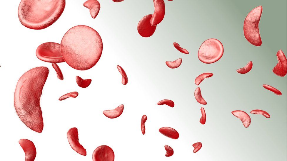 Visual Representation for sickle cells | Credits: Getty Images