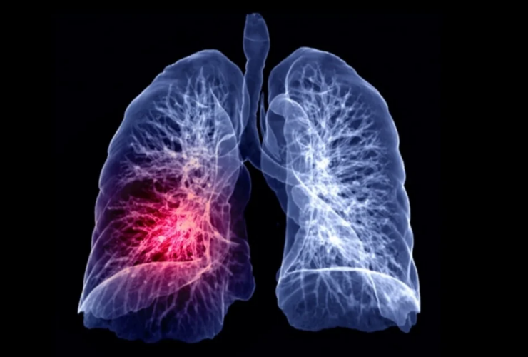 Breakthrough Drug Receives FDA Approval for Aggressive Lung Cancer Treatment